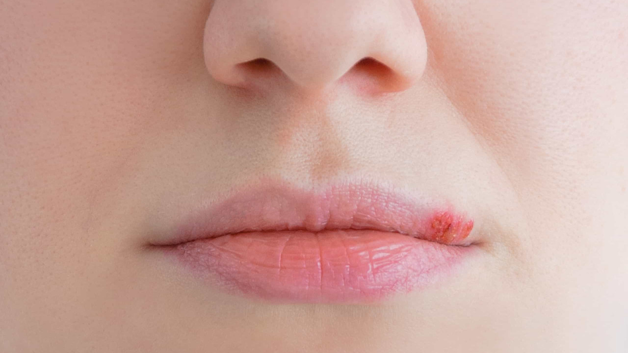 Há uma altura do ano em que a herpes labial é mais frequente