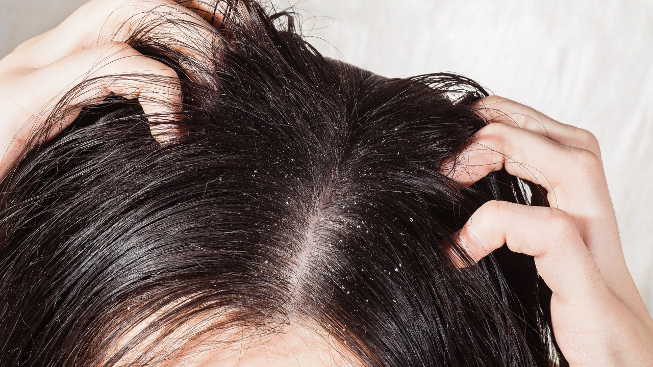 Goodbye dandruff.  Home remedy that promises to be the solution