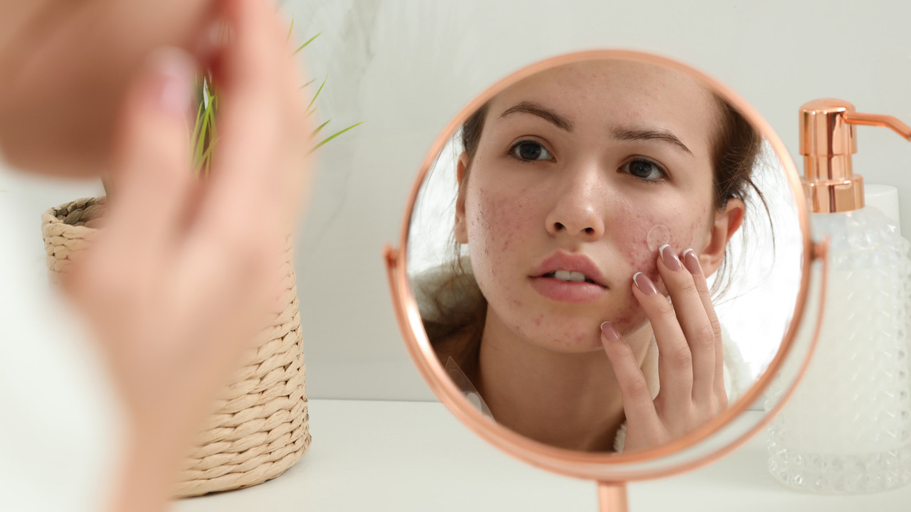 Como distinguir acne hormonal de acne causado pelo stress