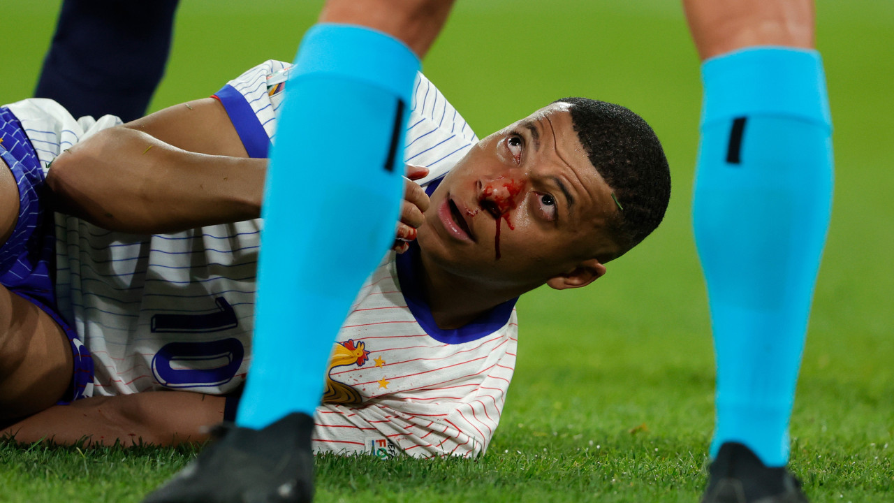 Dói só de ver: Mbappé ficou com o nariz neste estado e teve de sair