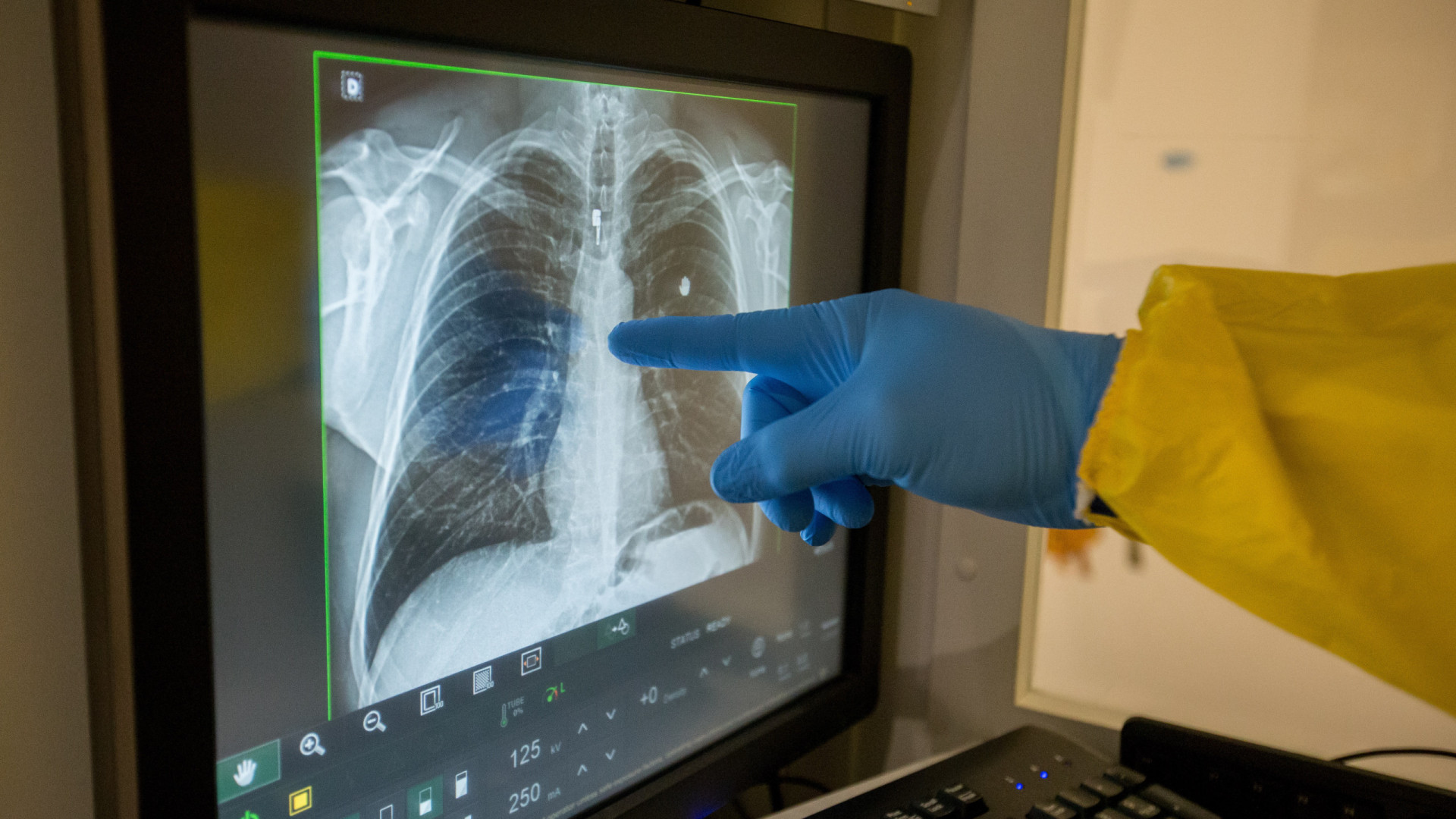 Novo rastreio do cancro no pulmão para fumadores e ex-fumadores 