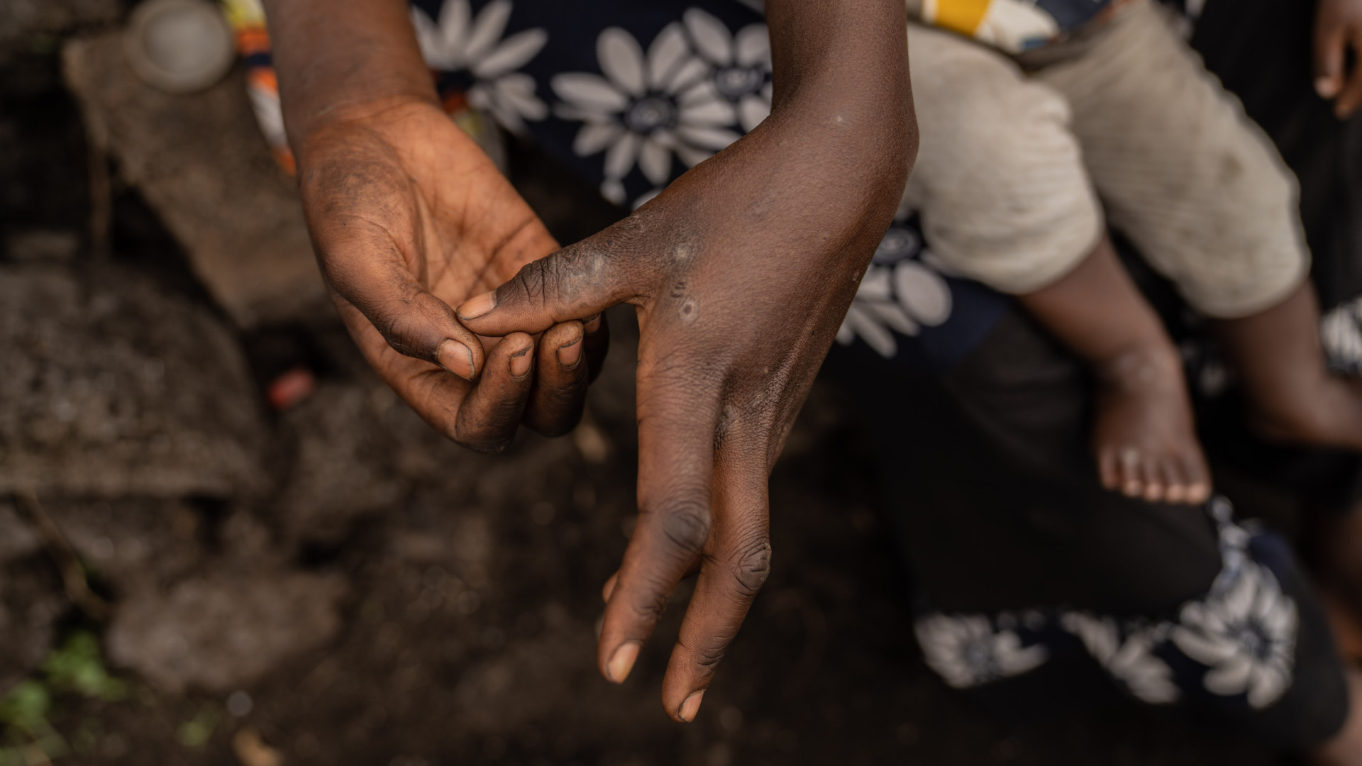 Infetados com mpox em Moçambique sobem para 38 e casos suspeitos para 325