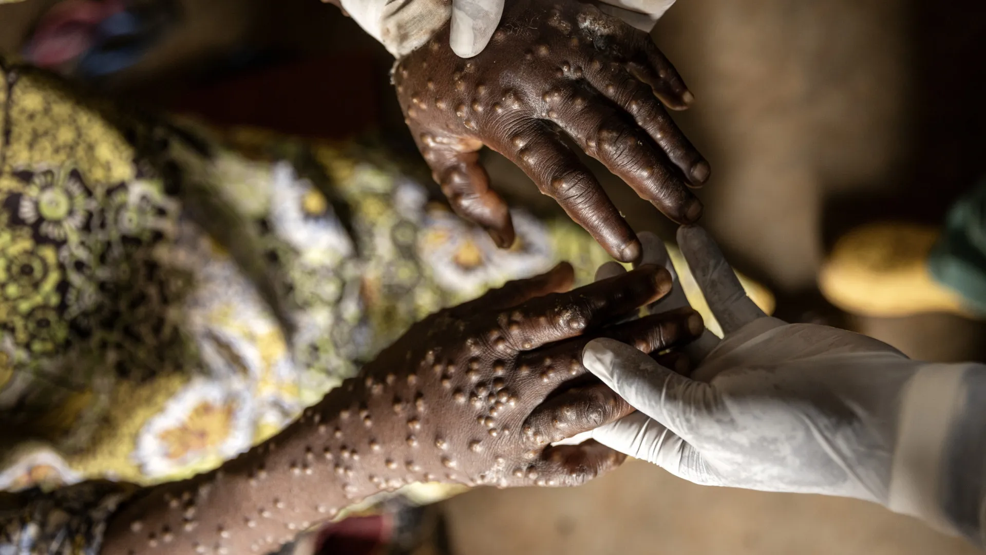 
                    Número de casos de mpox em Moçambique sobe para 66 e suspeitos para 810
                