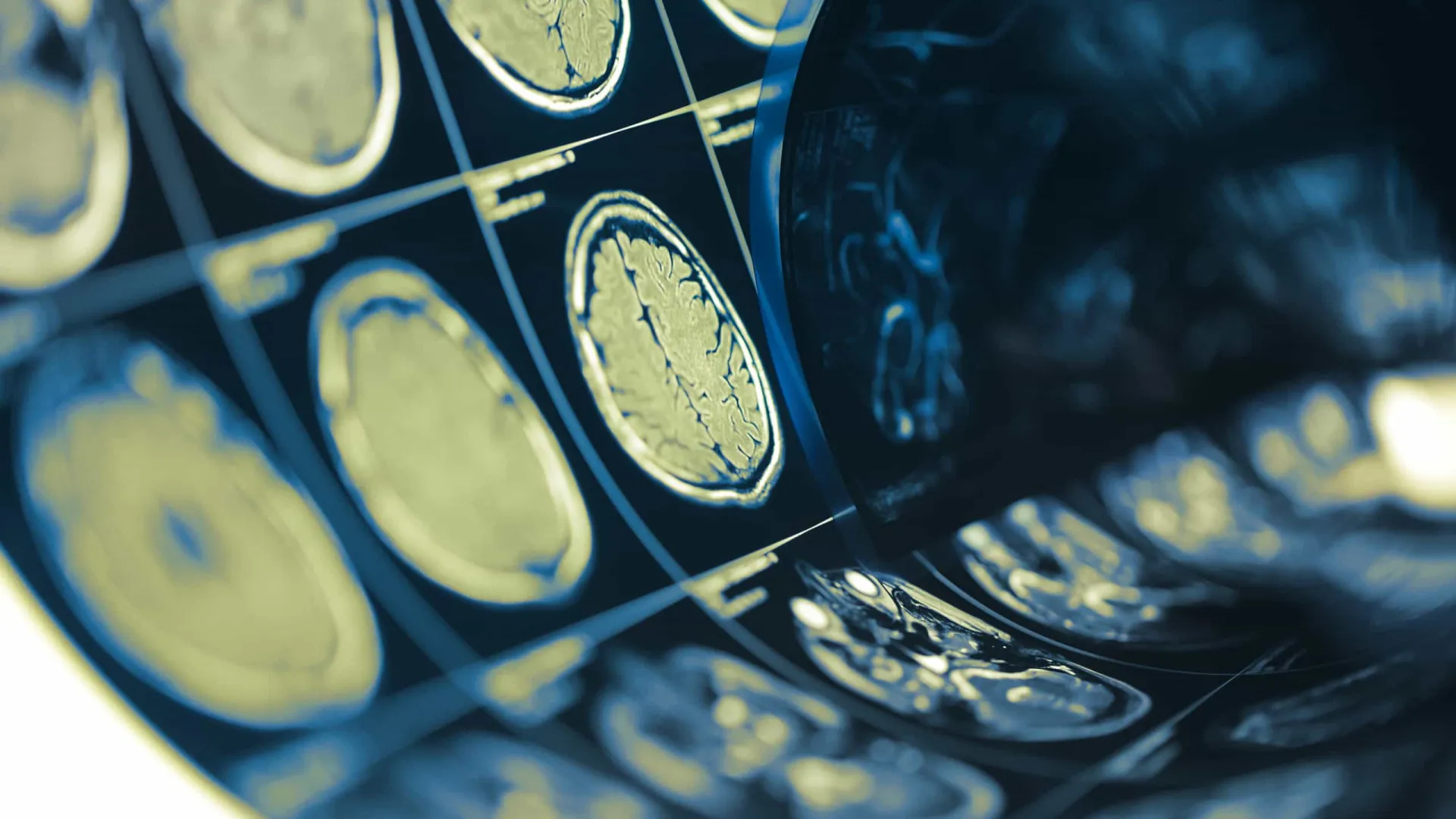 
                    FMUP estuda método para identificar risco de défice cognitivo após AVC
                