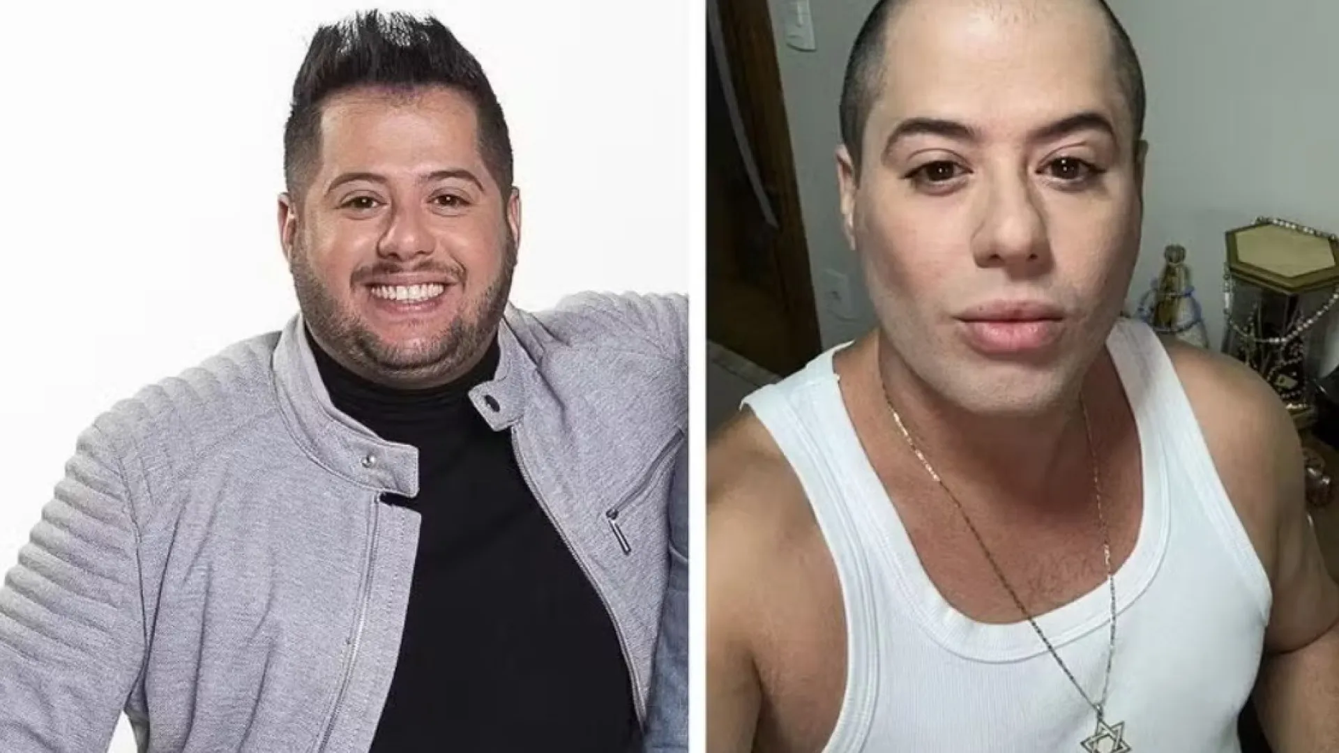 Sertanejo Hugo, da dupla com Tiago, surge bem diferente após harmonização