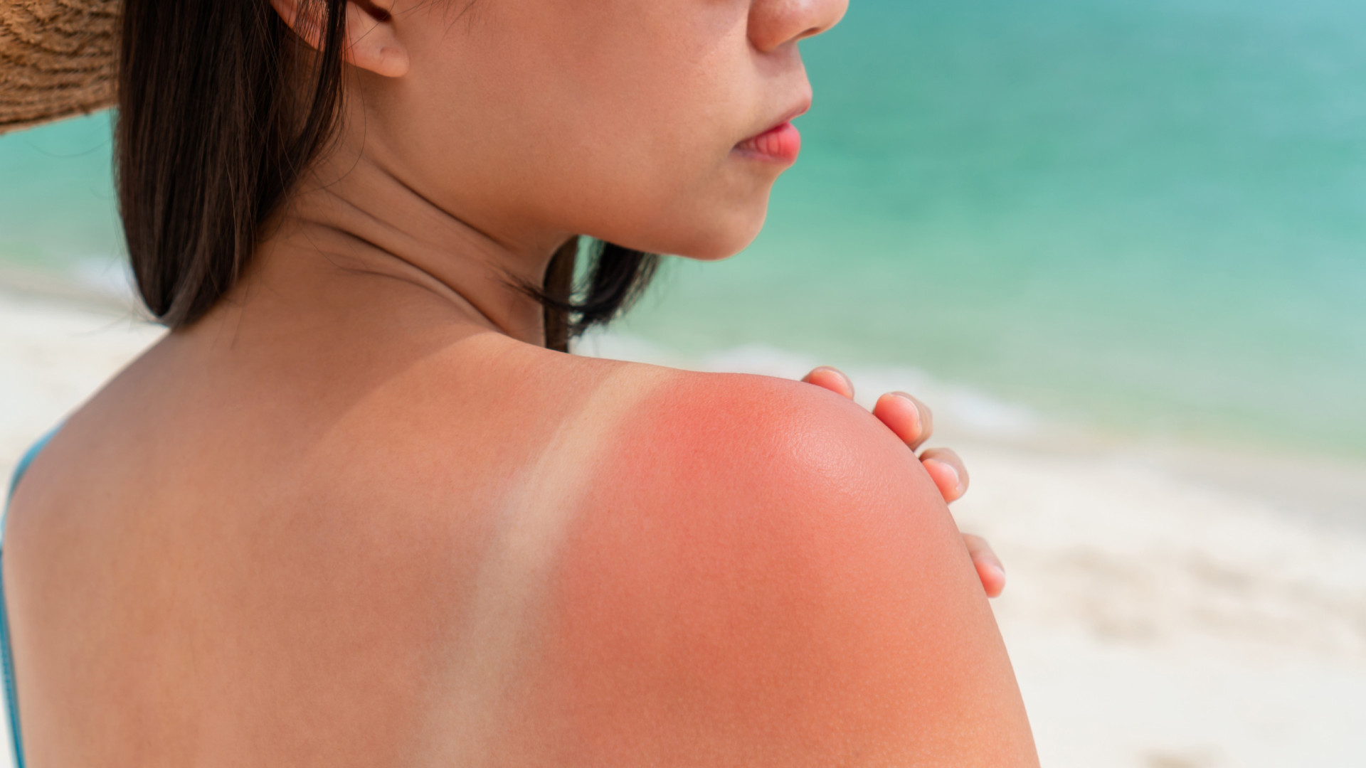 É assim que deve tratar uma queimadura solar, segundo dermatologistas