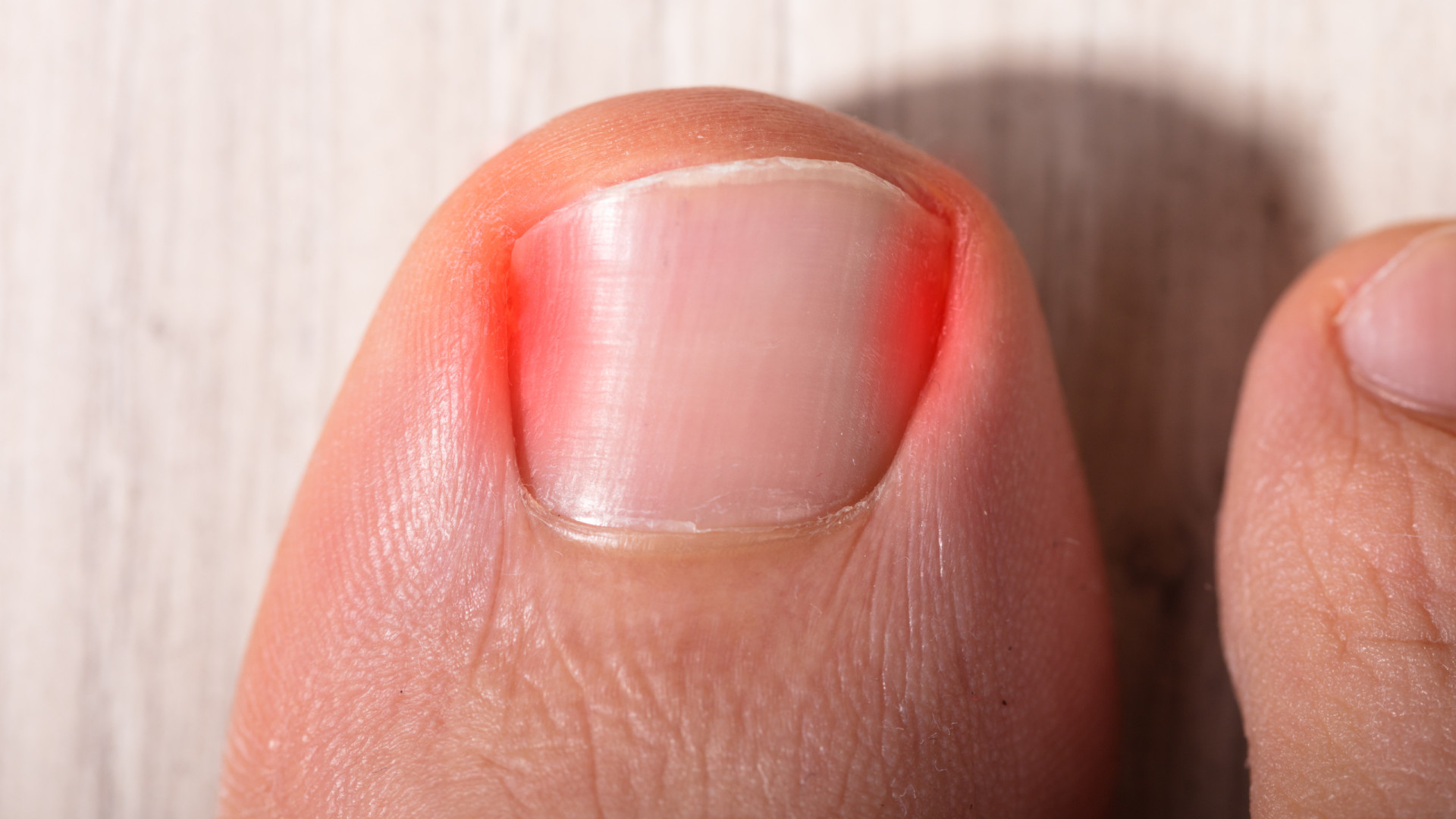 O que causa e como pode prevenir as unhas encravadas