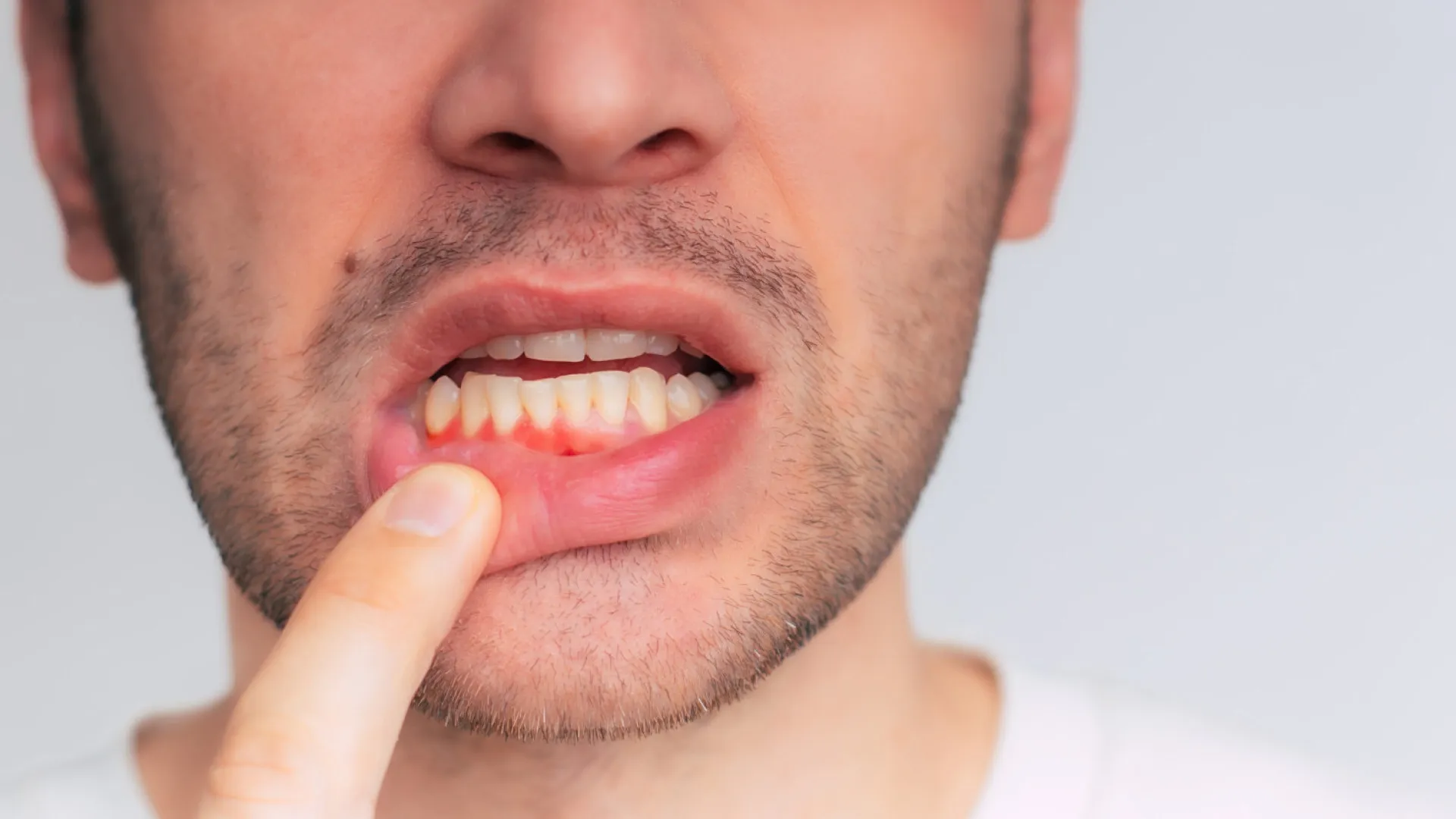 
                    Nem só o açúcar. Consumo em excesso deste alimento pode afetar saúde oral
                