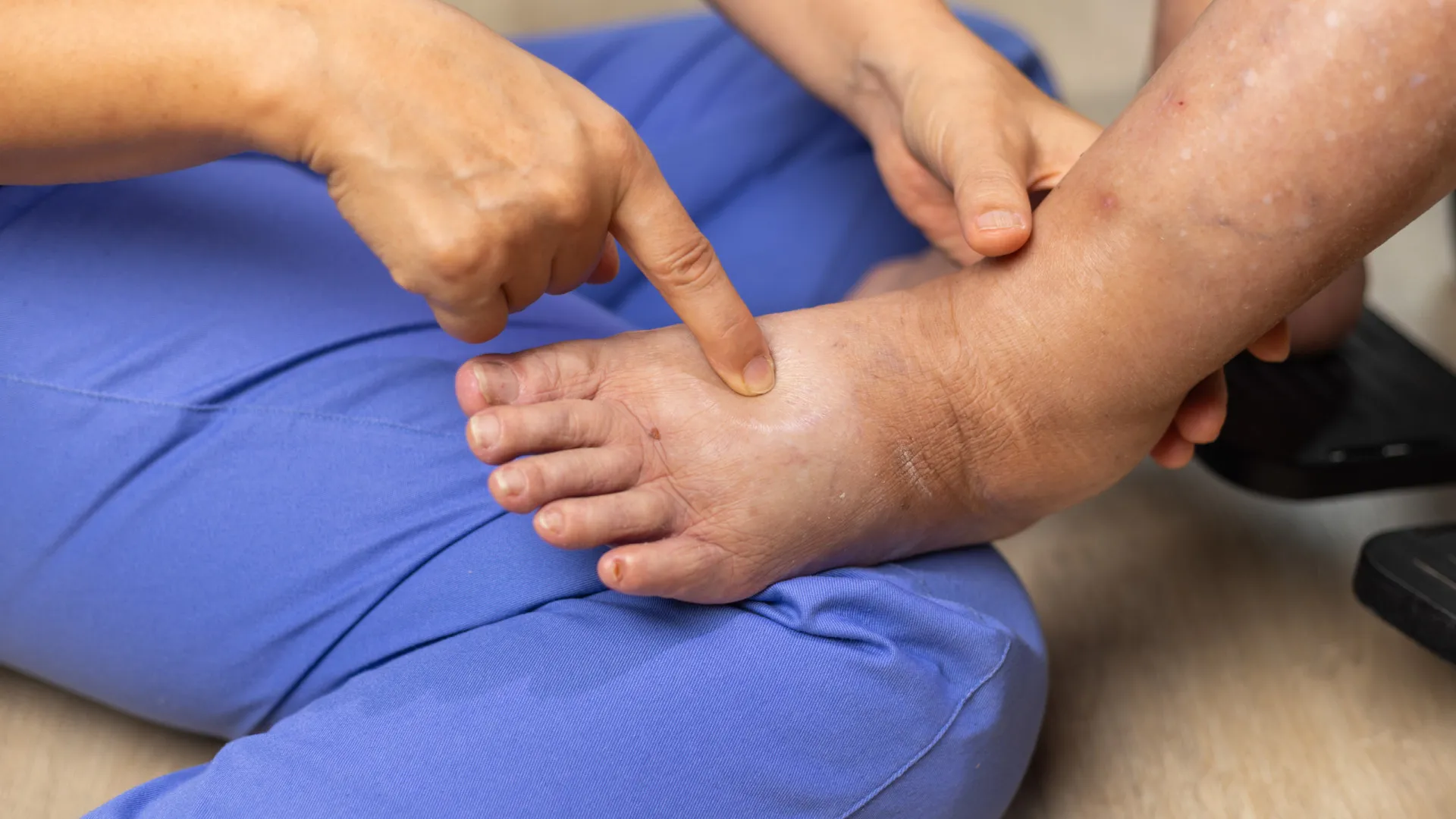Inchaço desproporcional nas pernas. Será um lipedema ou linfedema?