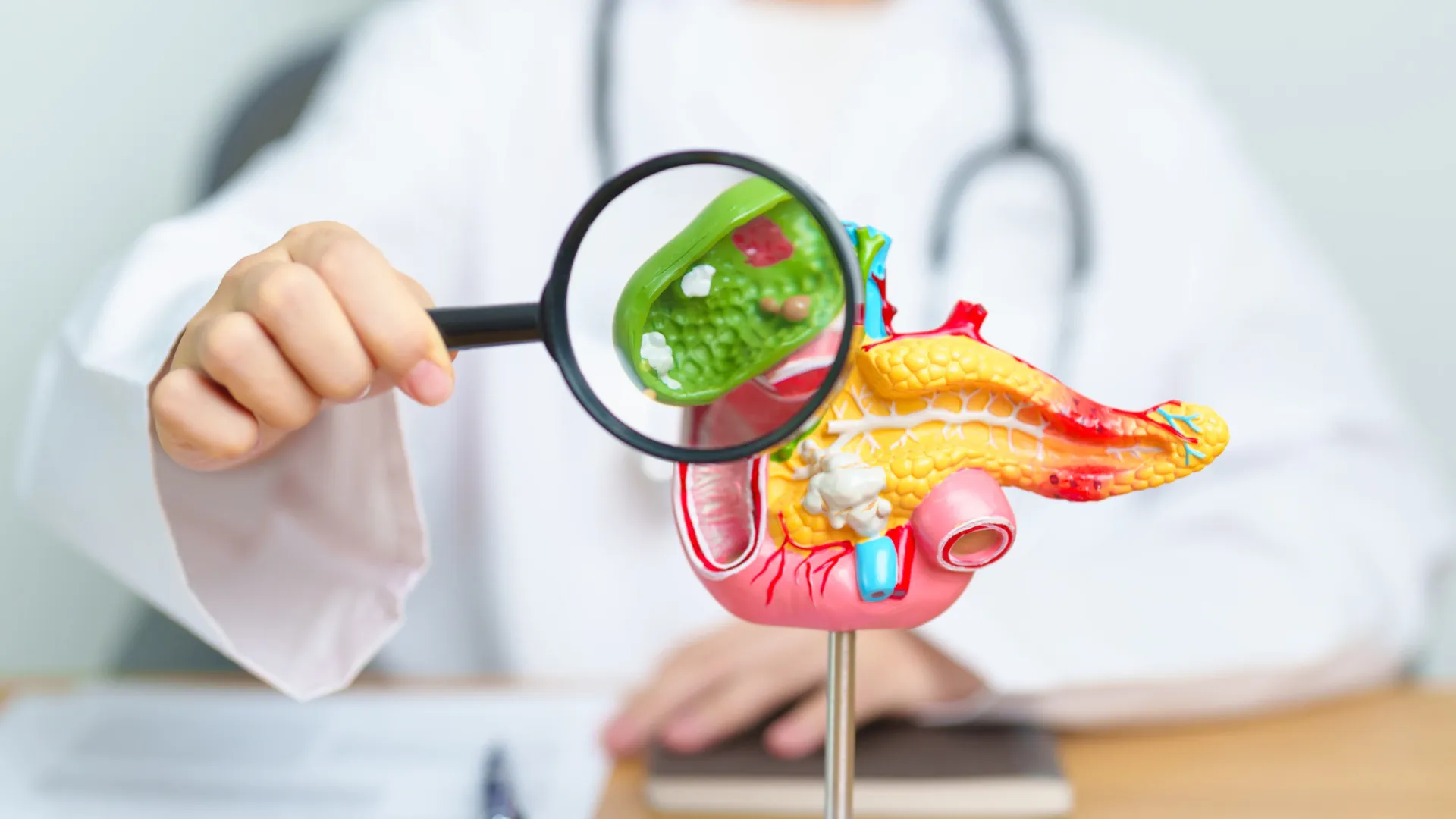 
                    Cancro do pâncreas: 