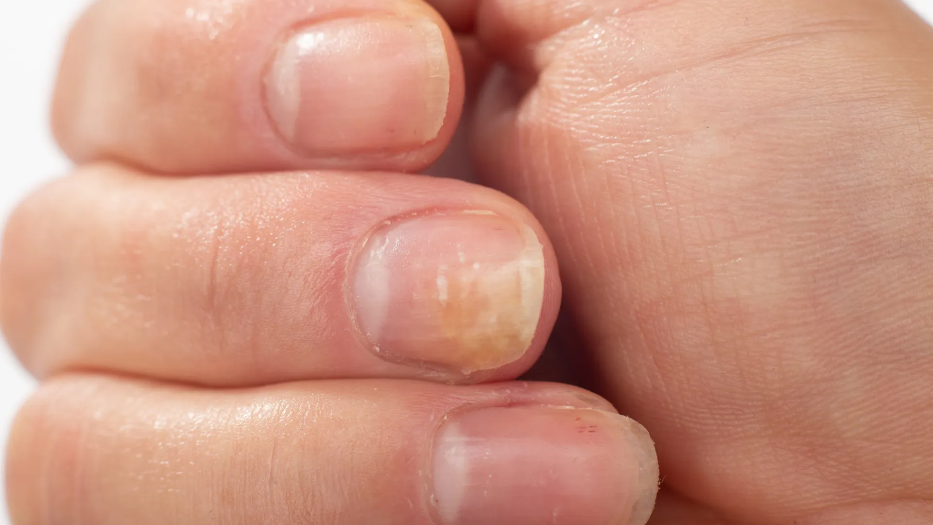 
                    Dermatologista revela o que as unhas podem dizer sobre a sua saúde
                