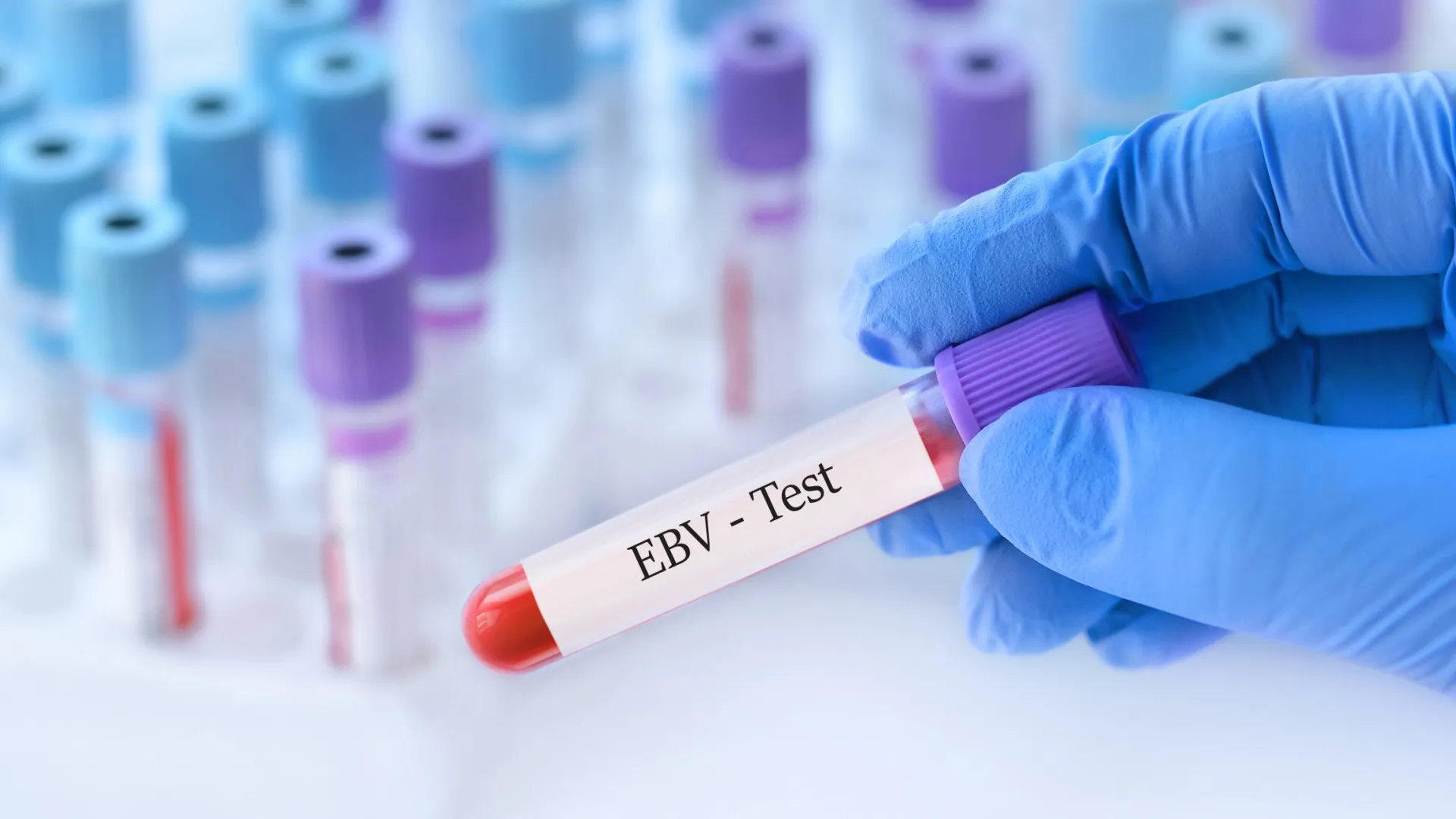 
                    Vírus Epstein-Barr pode causar esclerose múltipla, revela estudo
                