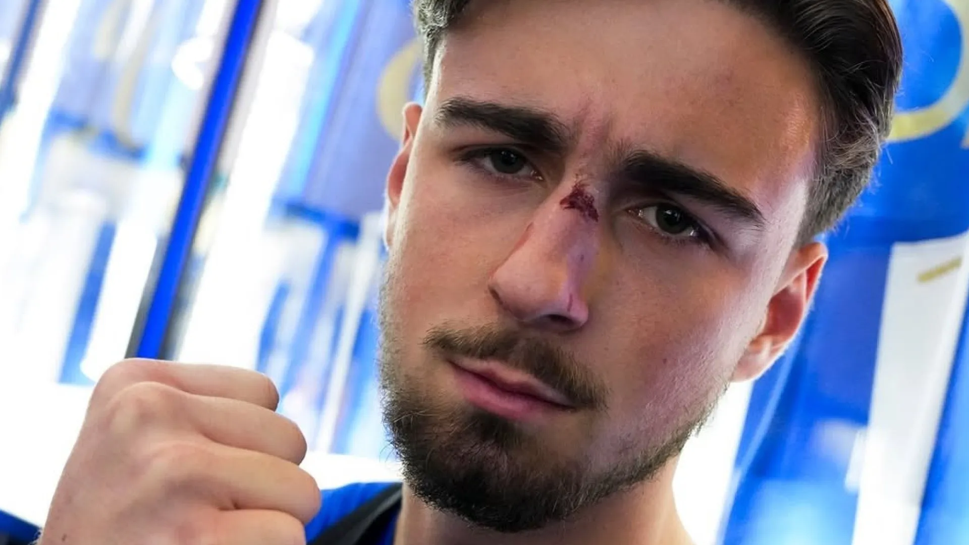 
                    FC Porto revela estado do nariz de Martim Fernandes após o Clássico
                