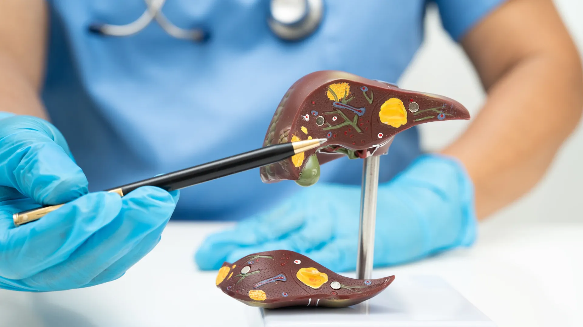 
                    Fígado gordo. 5 sintomas a que deve estar atento (para além do cansaço)
                