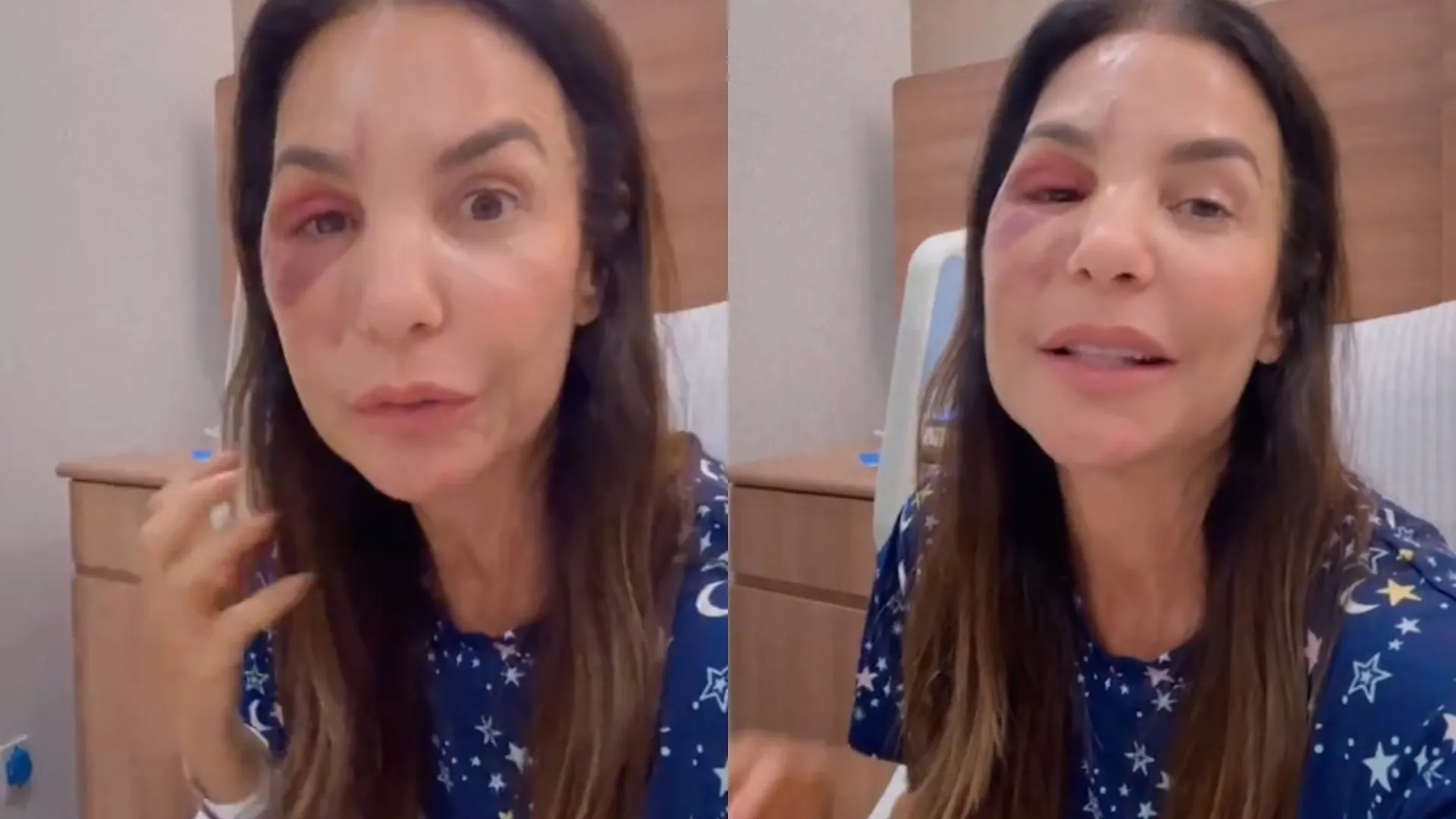 
                    Ivete Sangalo operada ao rosto após queda e desmaio: 