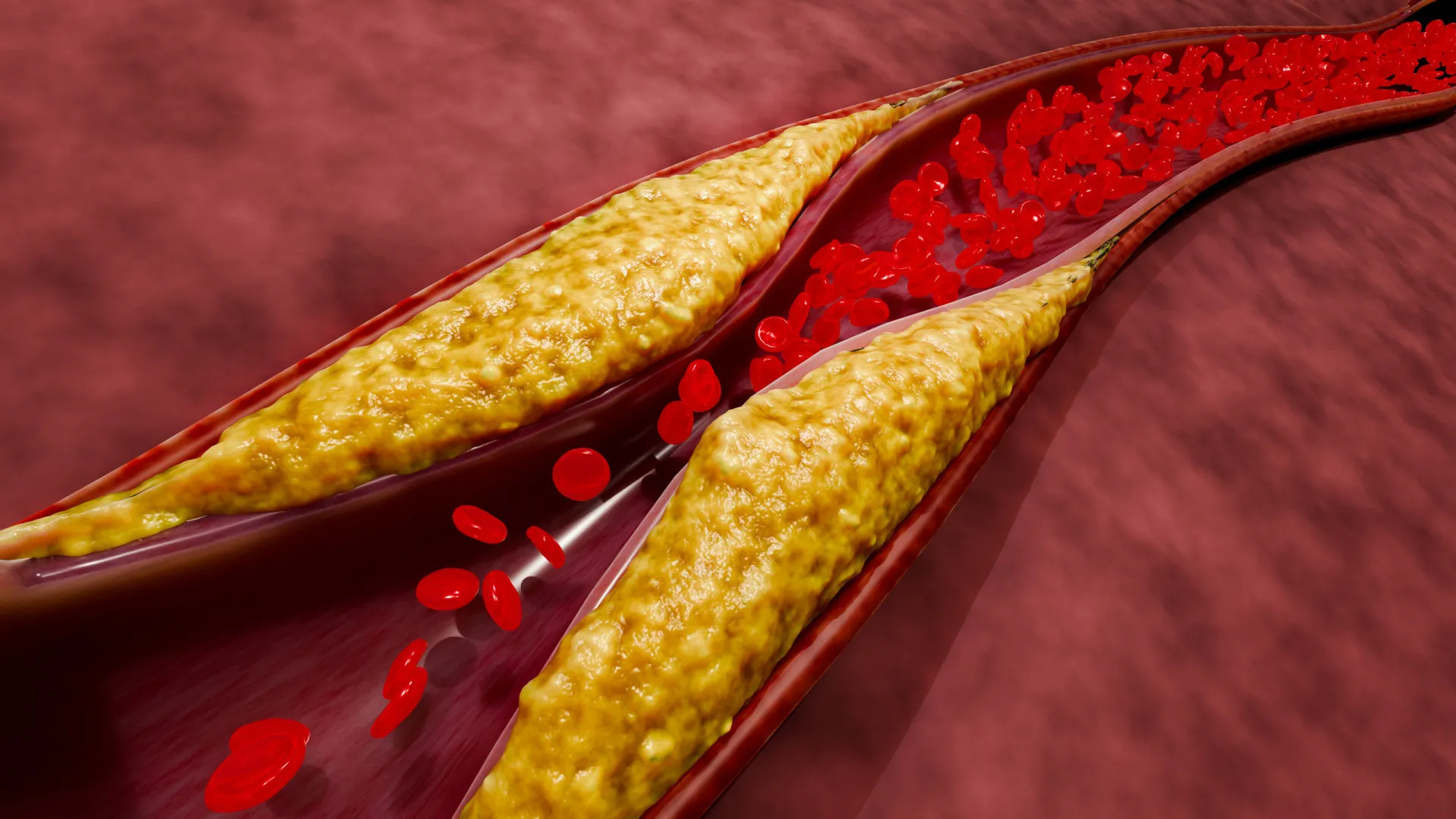 
                    Sinais de que as artérias podem estar entupidas, alerta cardiologista
                