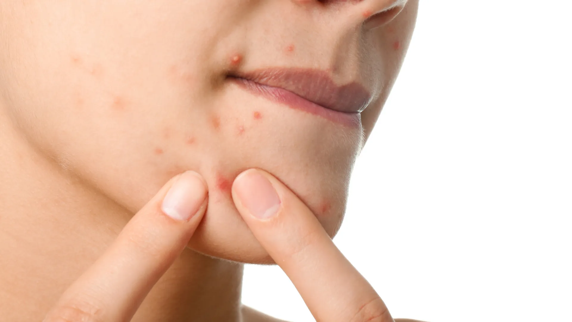 Os 3 piores alimentos para a pele: Os primeiros efeitos aparecem na cara