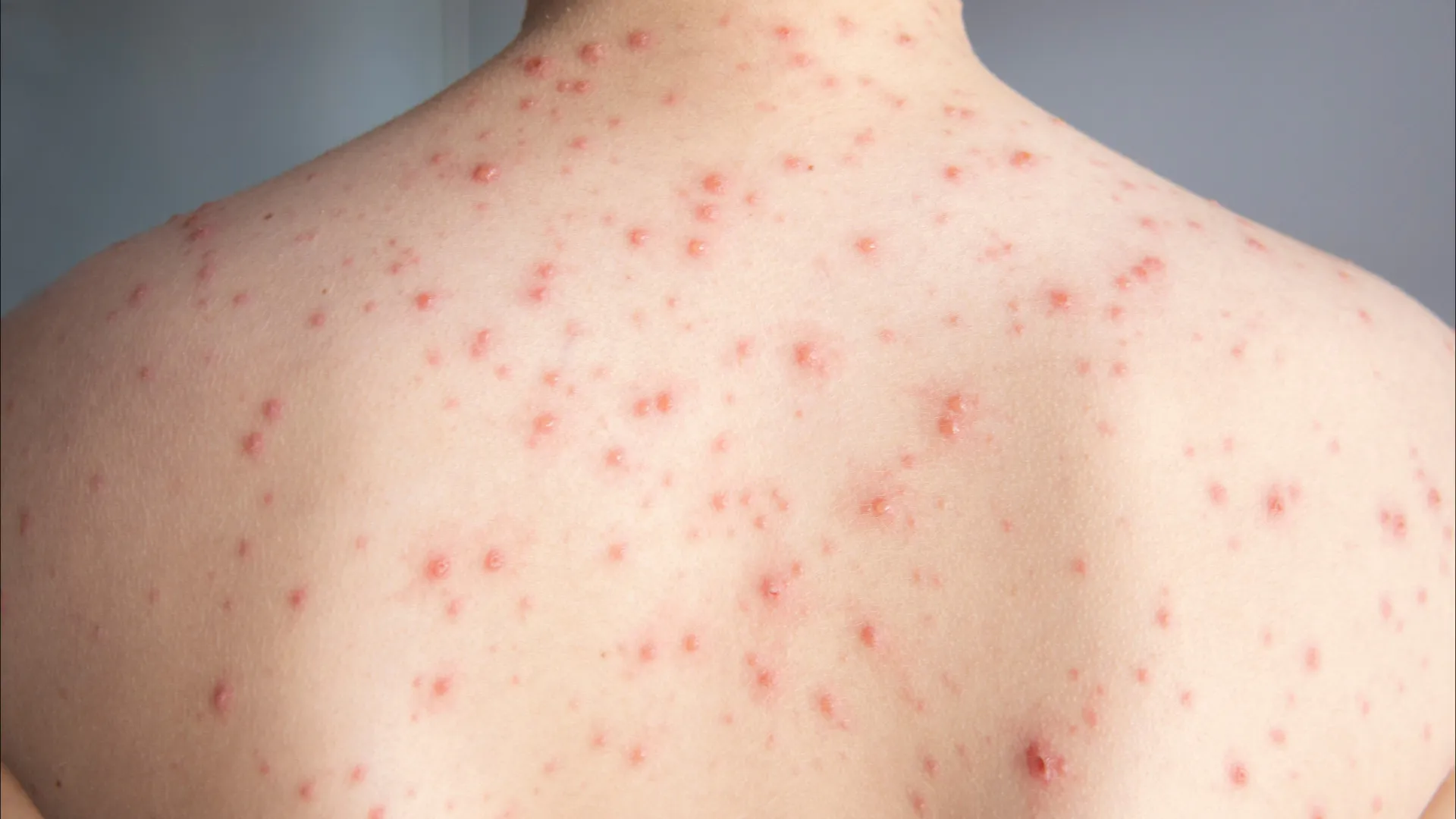 
                    Sarampo VS varicela. Qual é a pior idade para contrair estas doenças?
                