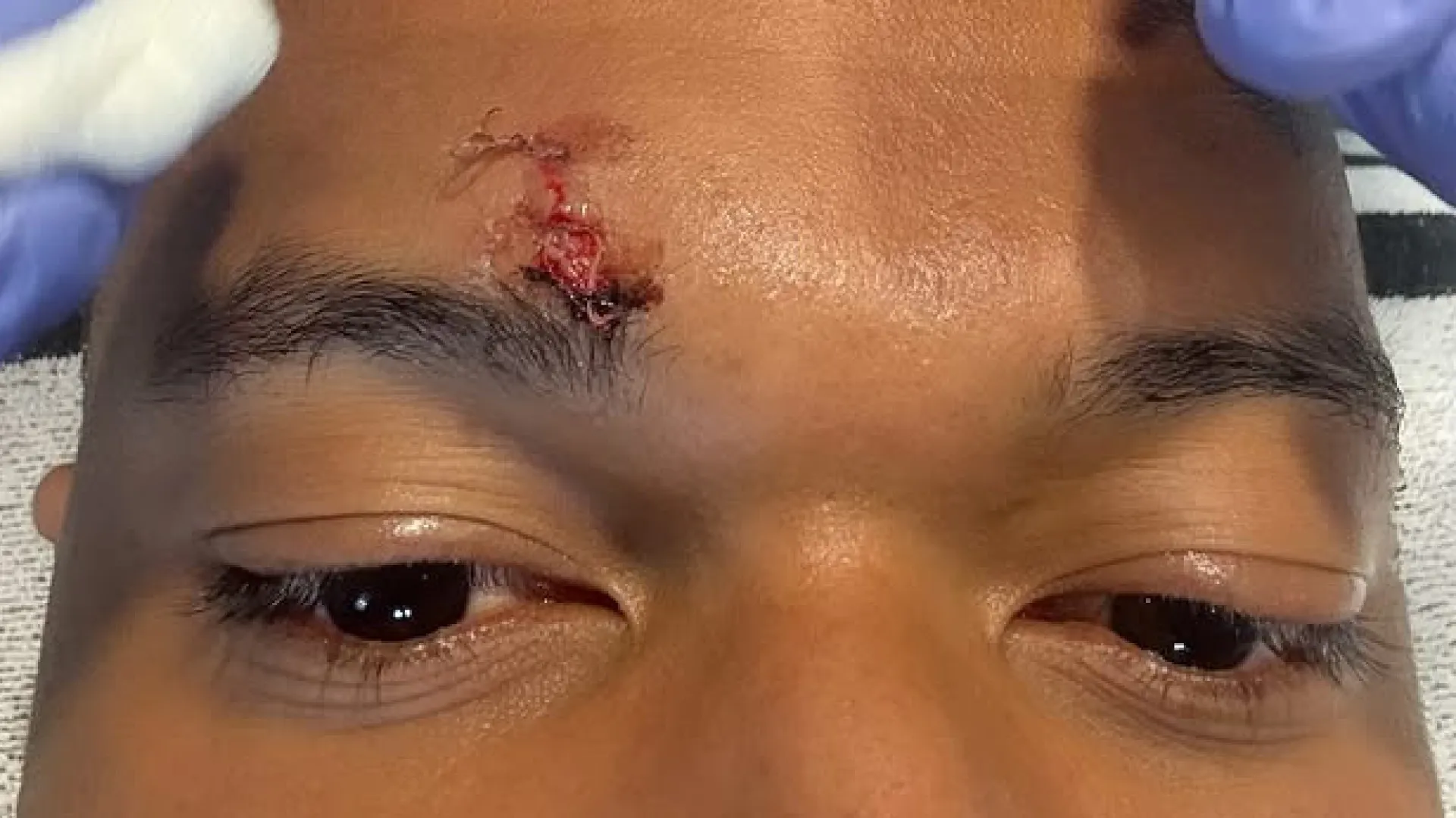 
                    Mbappé mostra mazelas no rosto após lance polémico no Real Madrid-Girona
                