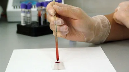 Leucemia? Teste de sangue poderá substituir amostras de medula na deteção
