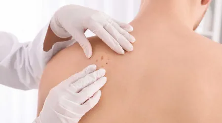 IPO do Porto está a realizar rastreios gratuitos de cancro de pele