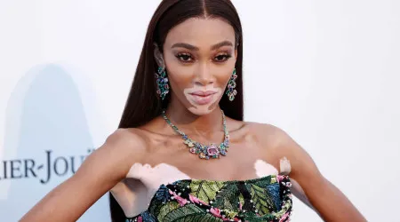 Esperança para vitiligo? Novo creme pode repor pigmentação da pele