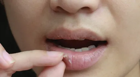 Está a ficar com os lábios secos e estas são as razões