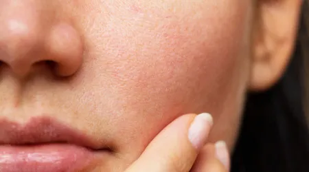 Pele seca? Esta máscara com três ingredientes vai ajudar