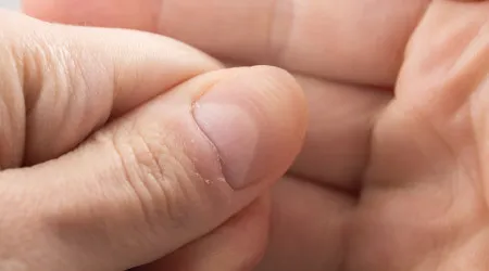 Cancro da pele grave vê-se nas unhas (mas sintoma é pouco falado)