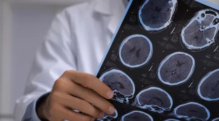 Novo tratamento contra esclerose múltipla pode estar a caminho