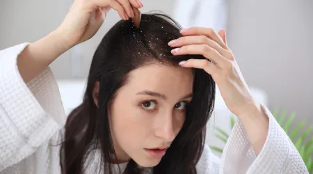 Dormir com cabelo molhado aumenta caspa? Especialista responde