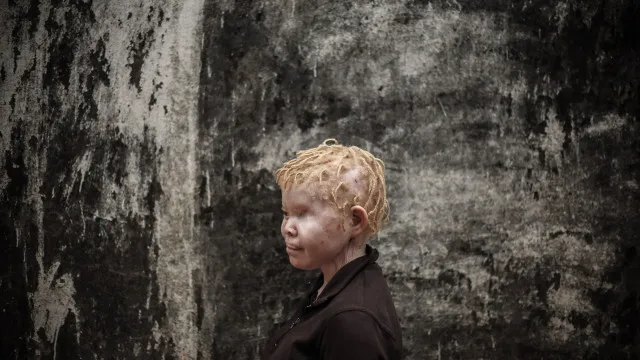 Associações moçambicanas pedem isenções em protetor solar para albinos