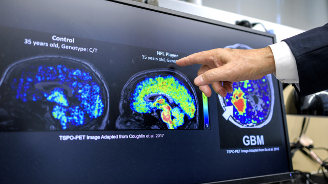 Erro na limpeza cerebral pode ser uma causa comum de Alzheimer e ELA