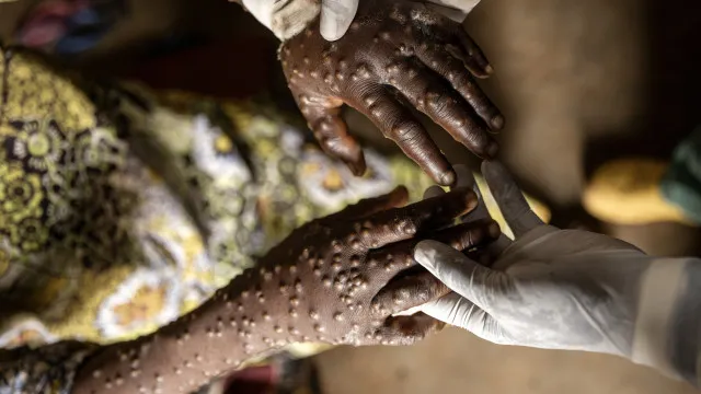 
                    Angola. Reforçada prevenção no Zaire após caso de mpox no Uíge
                