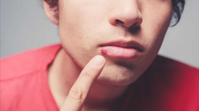 naom_5a46103071a87 Se tem herpes, atenção! Infarmed suspendeu lotes de dois medicamentos