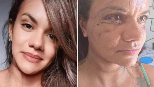 Agredida com 61 socos por ex-jogador mostra rosto dias após cirurgia