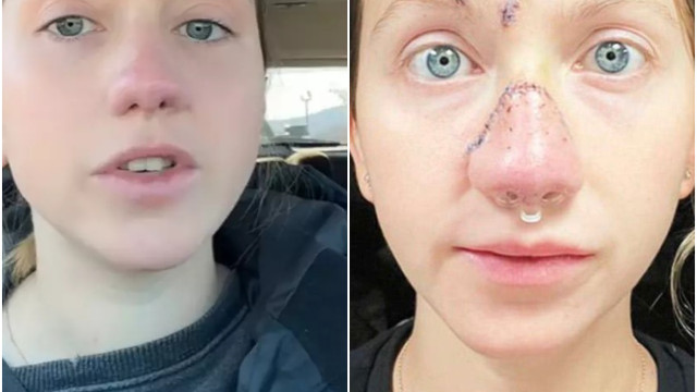 Mulher mostra rosto reconstruído após ter nariz arrancado por cão nos EUA