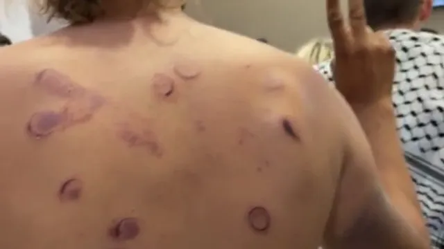 
                    Hematomas e fraturas: Ativistas da flotilha falam em tortura em Israel 
                