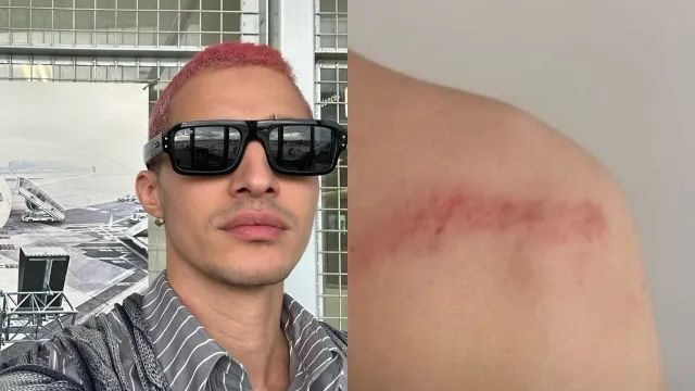 Luís Borges “sofre ataque homofóbico” e mostra hematomas