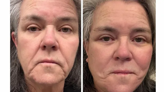 
                    Rosie O'Donnell faz lifting facial. 