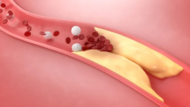 
                    Colesterol elevado? 5 alimentos prejudiciais, segundo especialistas
                