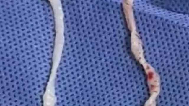 
                    China. Cozinhava rãs e acabou com dois parasitas de 10 cm no corpo
                