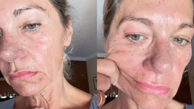 
                    Carolina Ortigão mostra (impressionante) antes e depois de operação 
                