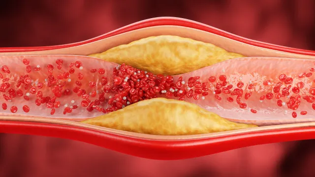 
                    5 sinais subtis de colesterol que não devem ser ignorados
                