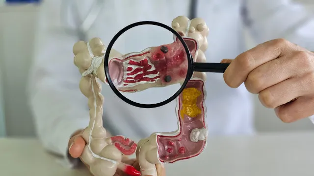 
                    Muita atenção! Este sintoma pouco falado pode indicar cancro colorretal
                