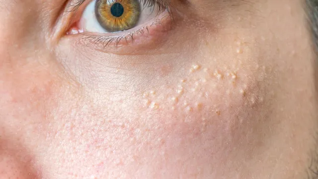 Porque Ã© que estas borbulhinhas aparecem ao pÃ© dos olhos?