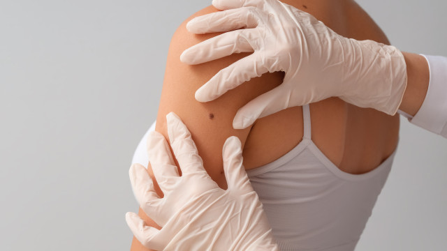 Cancro da pele. Do protetor só no verão aos solários, 10 mitos explicados