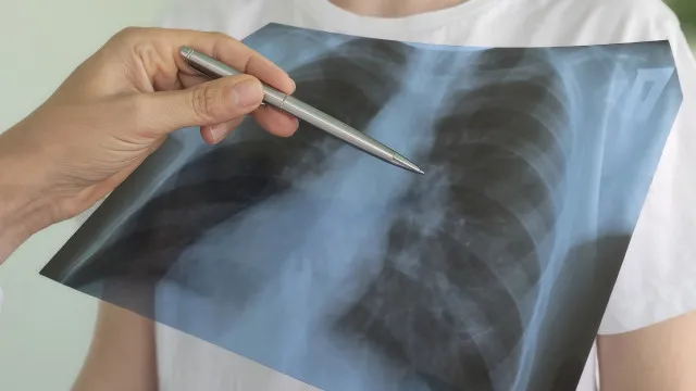 Cancro do pulmÃ£o: "O diagnÃ³stico comeÃ§a quando vencemos mitos"