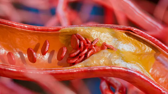 
                    O mau hábito que está a entupir as suas artérias, alerta cardiologista
                