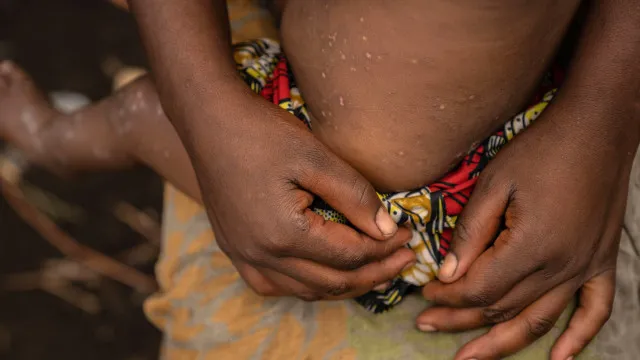 Cabo Verde reforça comunicação devido a surto de mpox na Guiné-Bissau